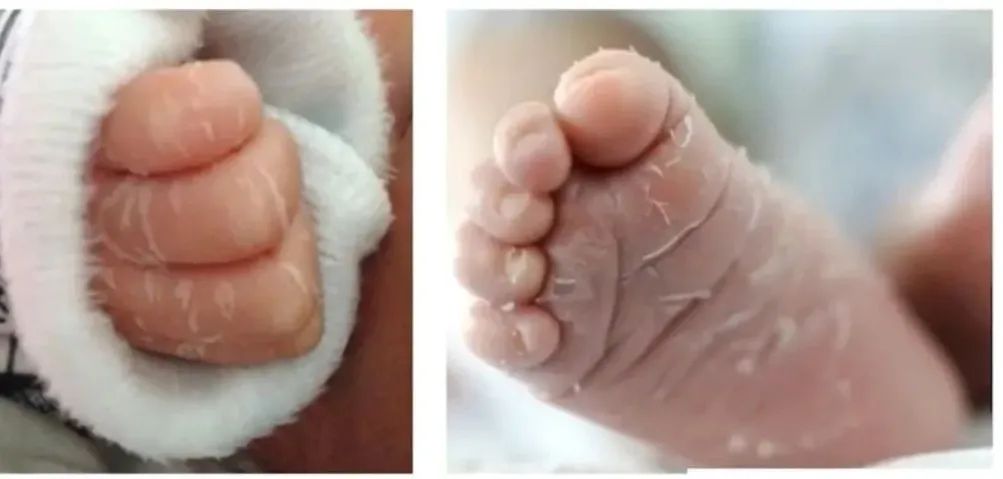 新生兒生理性蛻皮.jpg 新生兒生理性蛻皮.jpg