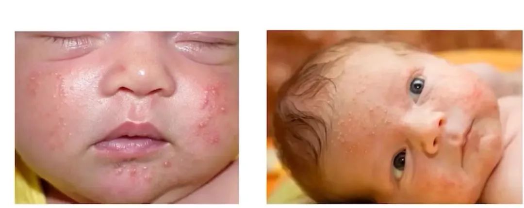 新生兒頭部膿皰病.jpg 新生兒頭部膿皰病.jpg