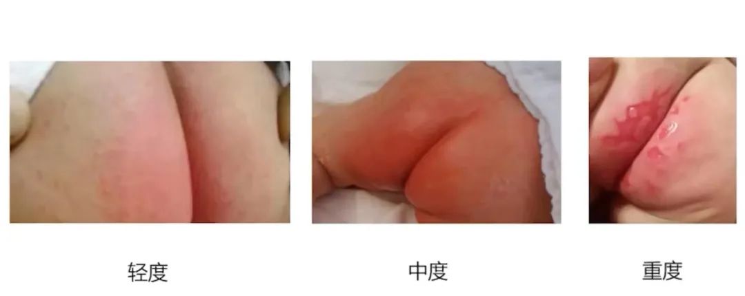 尿布疹.jpg 尿布疹.jpg