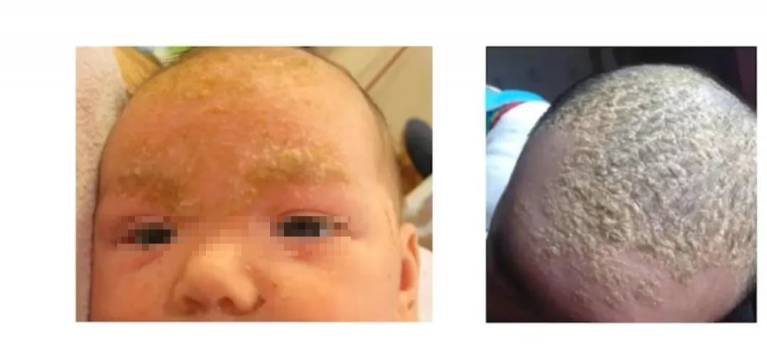 脂溢性皮炎.png 脂溢性皮炎.png